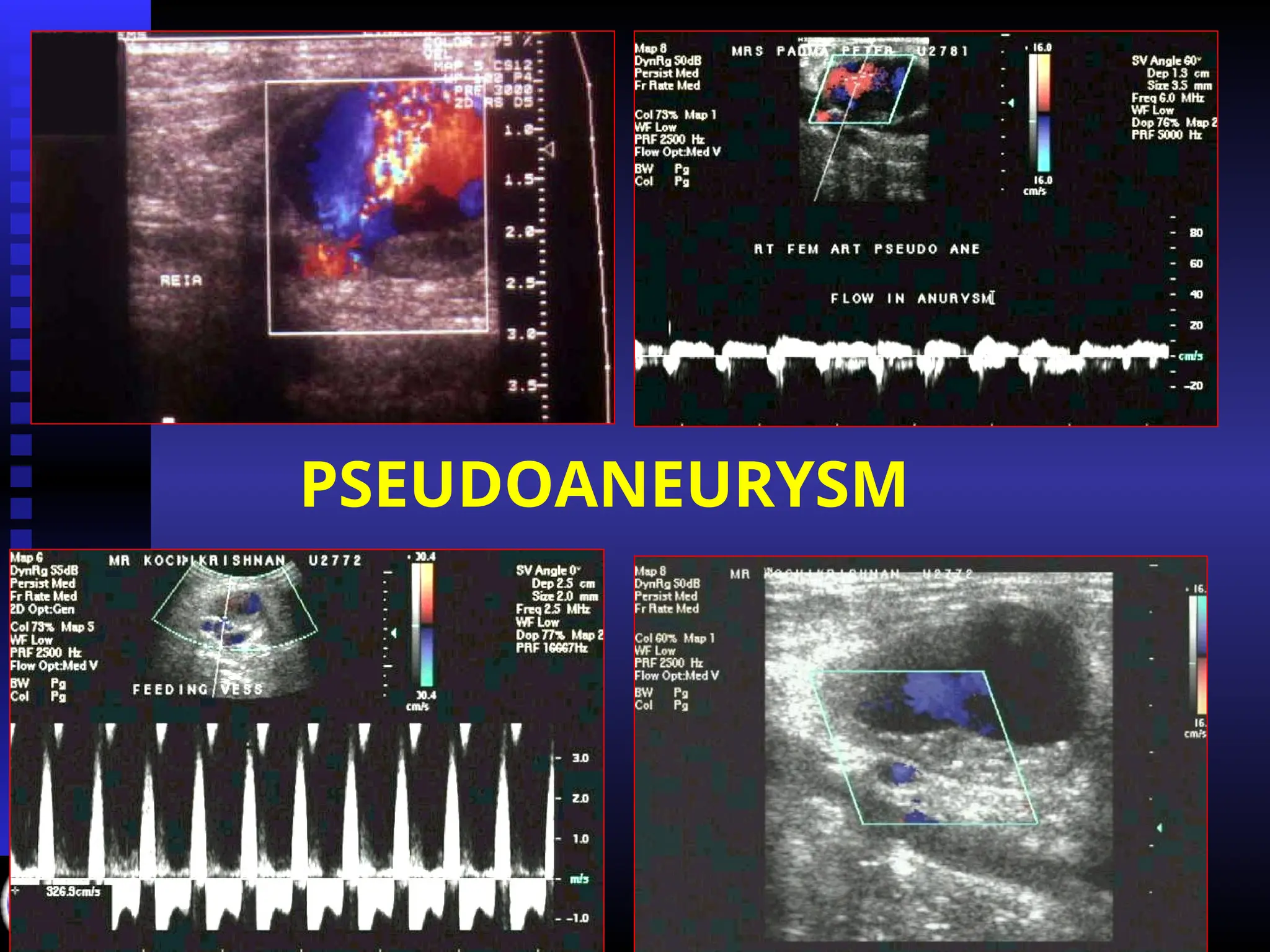 PSEUDOANEURYSM
 