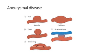 Aneurysmal disease
 