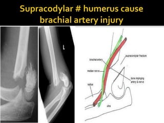 Arterial injury