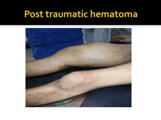 Arterial injury