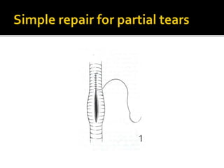 Arterial injury