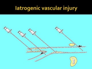 Arterial injury