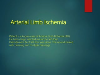Arterial Limb Ischemia
Patient is a known case of Arterial Limb Ischemia (ALI)
He had a large infected wound on left foot.
Debridement & of left foot was done. The wound healed
with cleaning and multiple dressings.
 