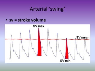 Arterial ‘swing’
• sv = stroke volume
 