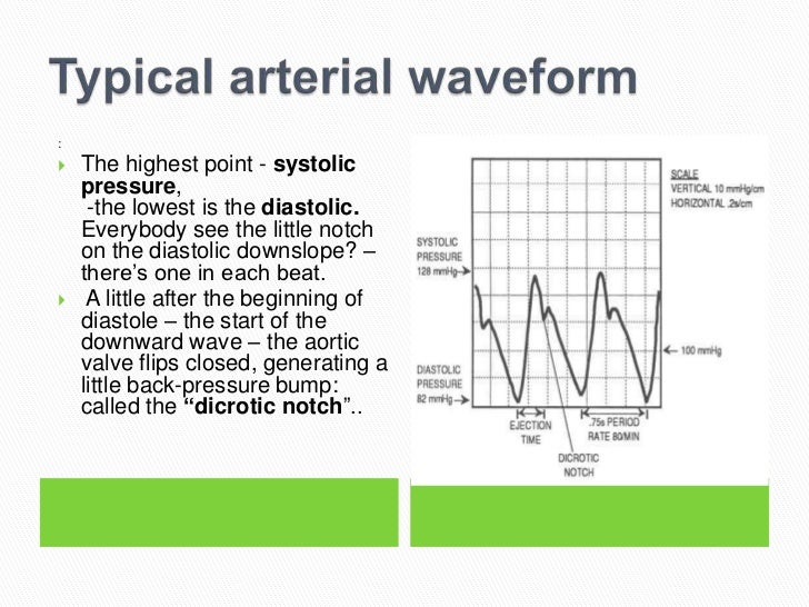 Arterial line insertion