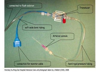 Arterial Line Setup Picture