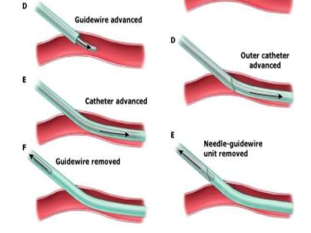 Arterial lines by Dr.Tinku Joseph