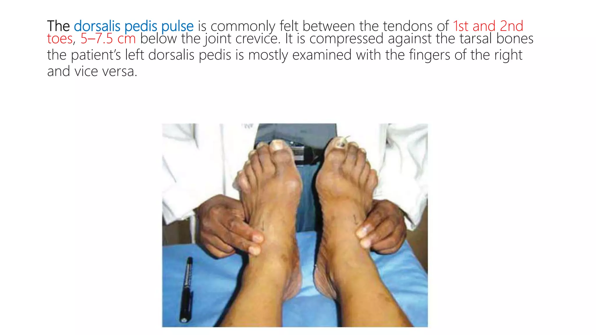 The dorsalis pedis pulse is commonly felt between the tendons of 1st and 2nd
toes, 5–7.5 cm below the joint crevice. It is compressed against the tarsal bones
the patient’s left dorsalis pedis is mostly examined with the fingers of the right
and vice versa.
 