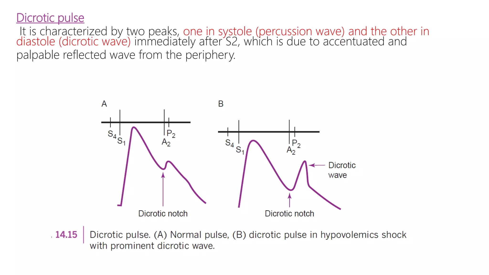 Dicrotic pulse
It is characterized by two peaks, one in systole (percussion wave) and the other in
diastole (dicrotic wave) immediately after S2, which is due to accentuated and
palpable reflected wave from the periphery.
 