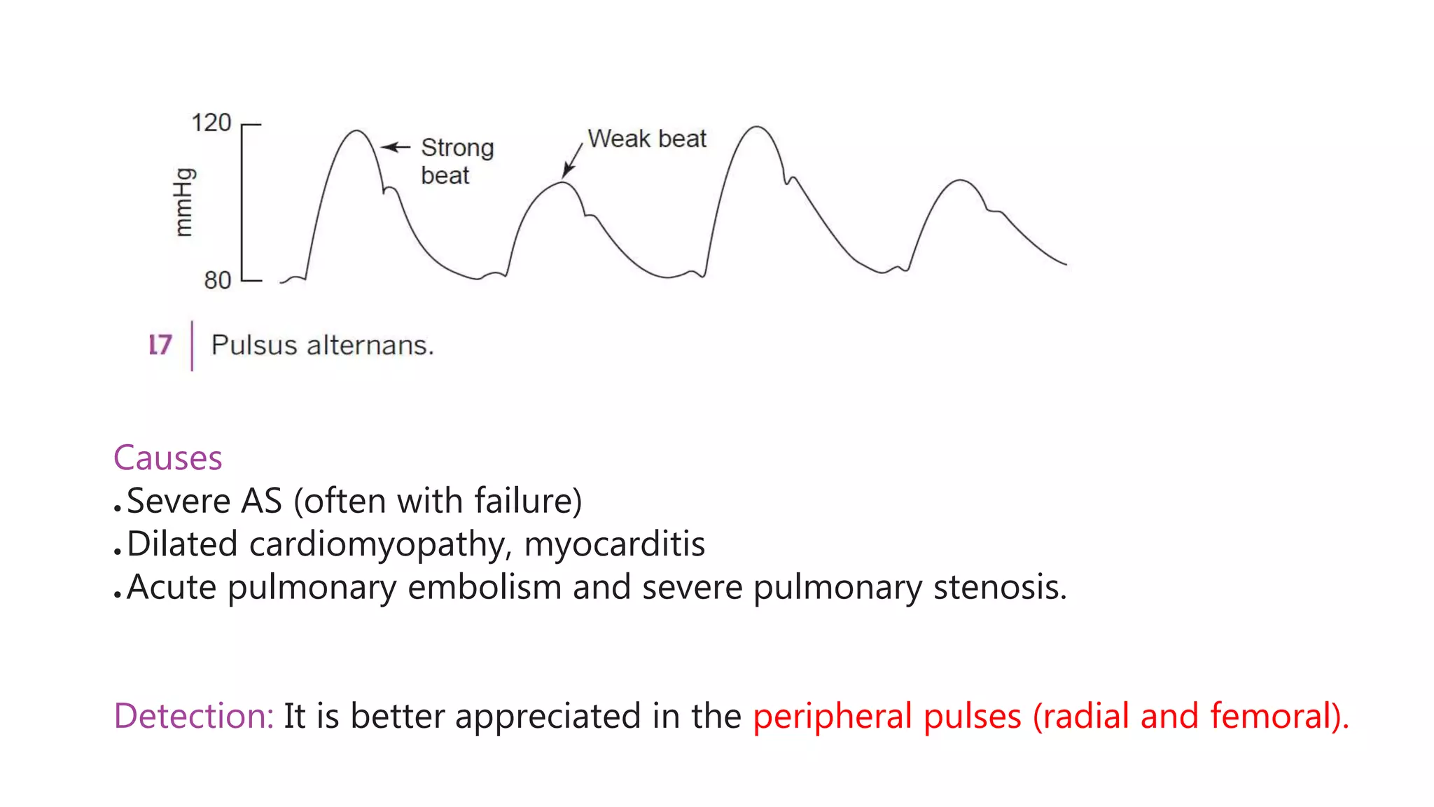 Causes
● Severe AS (often with failure)
● Dilated cardiomyopathy, myocarditis
● Acute pulmonary embolism and severe pulmonary stenosis.
Detection: It is better appreciated in the peripheral pulses (radial and femoral).
 
