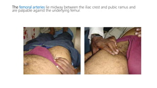The femoral arteries lie midway between the iliac crest and pubic ramus and
are palpable against the underlying femur.
 