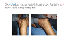 The popliteals are best examined with the patient’s knee flexed at an angle
of 120. The fingertips of both hands are placed in the popliteal fossa with
thumbs resting on the patient’s patella.
 