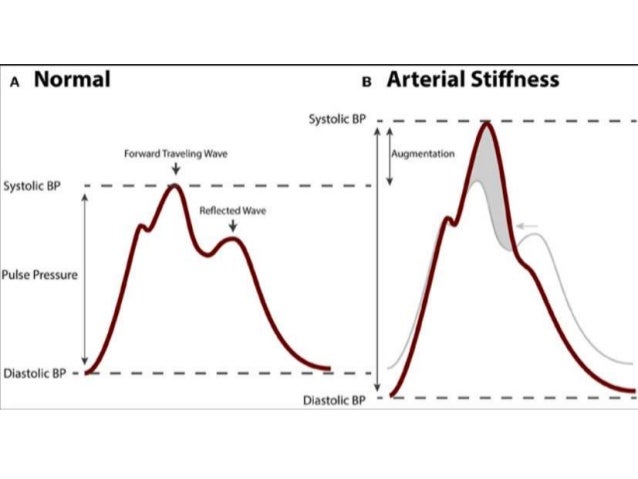 Arterial Stiffness