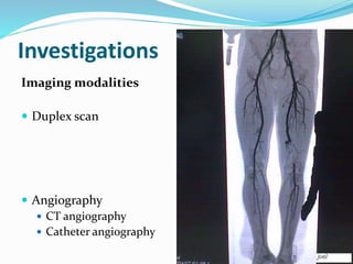 Investigations
Imaging modalities
 Duplex scan
 Angiography
 CT angiography
 Catheter angiography
 