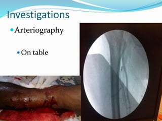 Investigations
Arteriography
 On table
 