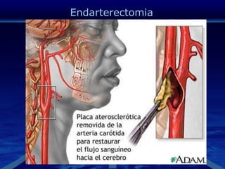 Endarterectomia
