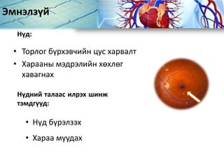Эмнэлзүй
• Торлог бүрхэвчийн цус харвалт
• Харааны мэдрэлийн хөхлөг
хавагнах
Нүд:
Нүдний талаас илрэх шинж
тэмдгүүд:
• Нүд бүрэлзэх
• Хараа муудах
 