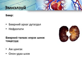 Эмнэлзүй
Бөөр:
• Бөөрний архаг дутагдал
• Нефропати
Бөөрний талаас илрэх шинж
тэмдгүүд:
• Ам цангах
• Олон удаа шээх
 