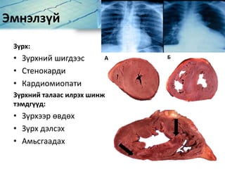 Эмнэлзүй
Зүрх:
• Зүрхний шигдээс
• Стенокарди
• Кардиомиопати
Зүрхний талаас илрэх шинж
тэмдгүүд:
• Зүрхээр өвдөх
• Зүрх дэлсэх
• Амьсгаадах
А Б
 
