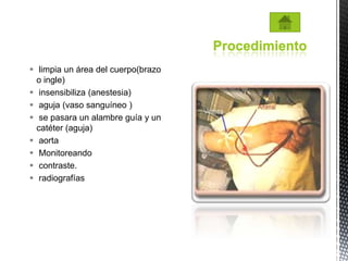 Procedimiento
 limpia un área del cuerpo(brazo
  o ingle)
 insensibiliza (anestesia)
 aguja (vaso sanguíneo )
 se pasara un alambre guía y un
  catéter (aguja)
 aorta
 Monitoreando
 contraste.
 radiografías
 