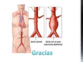 Arteriografía