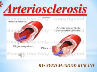 *Arteriosclerosis
BY: SYED MASOOD RUBANI
 