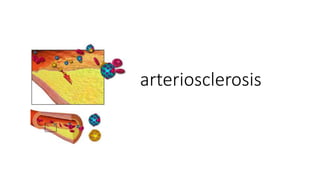 arteriosclerosis
 