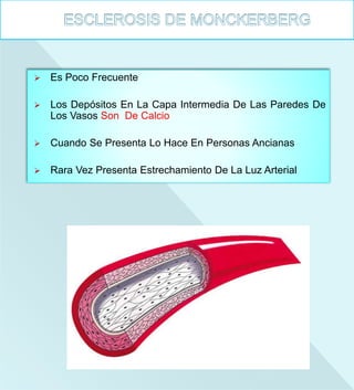  Es Poco Frecuente
 Los Depósitos En La Capa Intermedia De Las Paredes De
Los Vasos Son De Calcio
 Cuando Se Presenta Lo Hace En Personas Ancianas
 Rara Vez Presenta Estrechamiento De La Luz Arterial
 