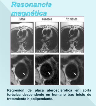 Regresión de placa aterosclerótica en aorta
torácica descendente en humano tras inicio de
tratamiento hipolipemiante.
 