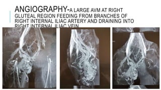ANGIOGRAPHY-A LARGE AVM AT RIGHT
GLUTEAL REGION FEEDING FROM BRANCHES OF
RIGHT INTERNAL ILIAC ARTERY AND DRAINING INTO
RIGHT INTERNAL ILIAC VEIN
 