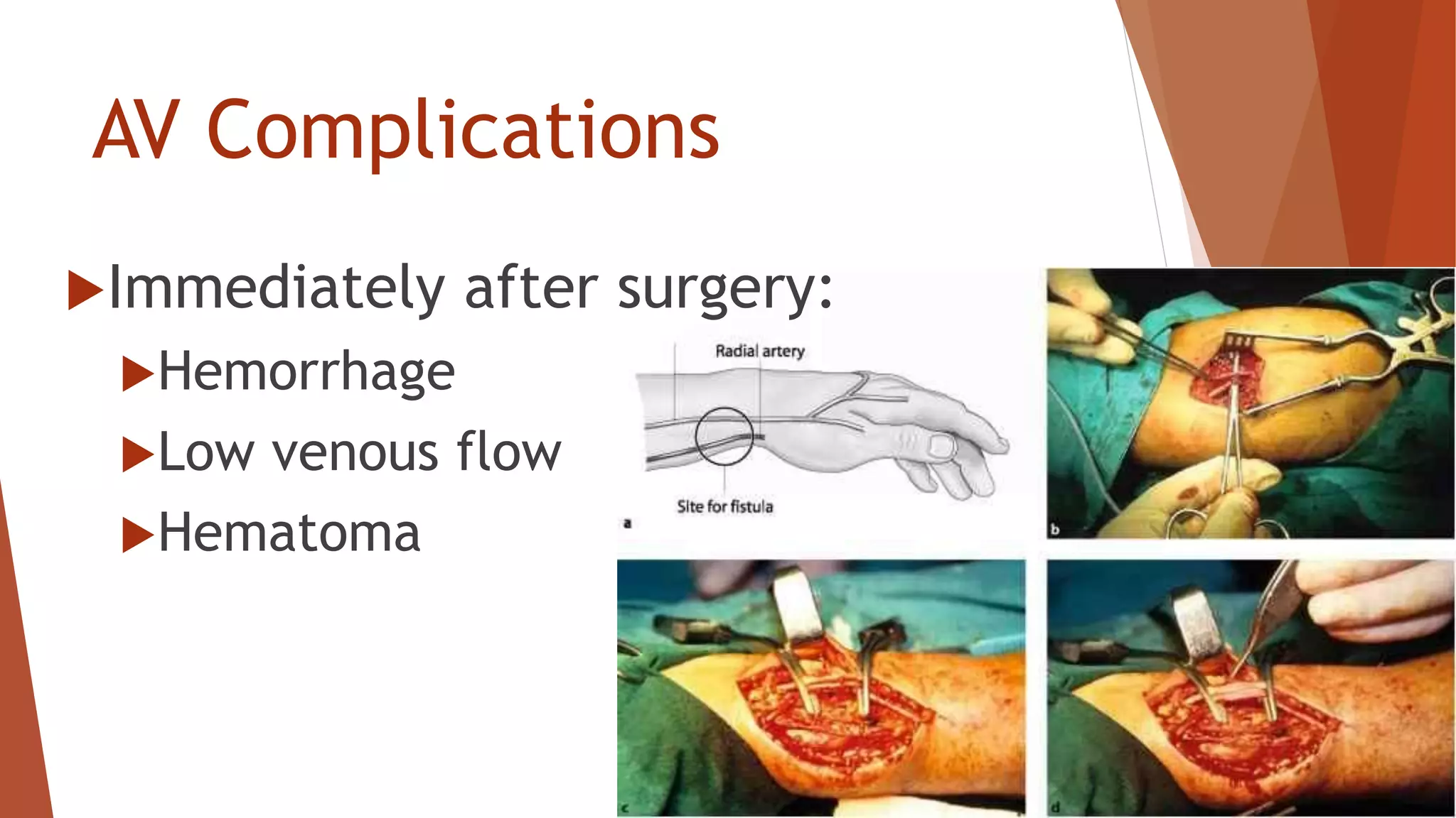 AV Complications
Immediately after surgery:
Hemorrhage
Low venous flow
Hematoma