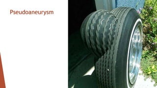 Pseudoaneurysm