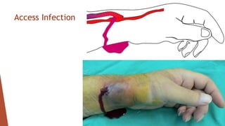 Access Infection