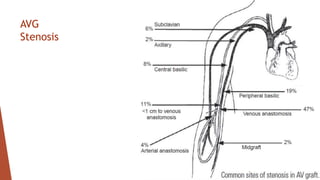 AVG
Stenosis