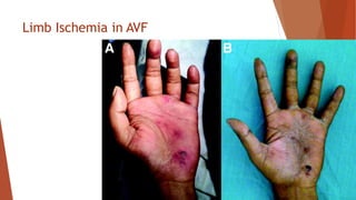Limb Ischemia in AVF