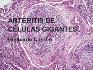 ARTERITIS DE
CÉLULAS GIGANTES
Guilbardo Carrillo
 
