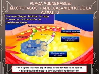 • La degradación de la capa fibrosa alrededor del núcleo lipídico
• La degradación del tejido conectivo en el núcleo lipídico.
• La degradación de la capa fibrosa alrededor del núcleo lipídico
• La degradación del tejido conectivo en el núcleo lipídico.
Los macrófagos debilitan la capa
fibrosa por la liberación de
metaloproteasas
 