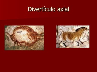 Divertículo axial 