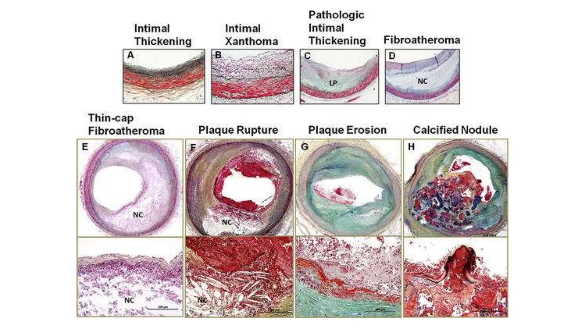 Artery and atherosclerosis anatomy and pathology | PPT