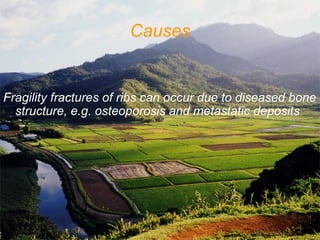 Causes
Fragility fractures of ribs can occur due to diseased bone
structure, e.g. osteoporosis and metastatic deposits
–    
 