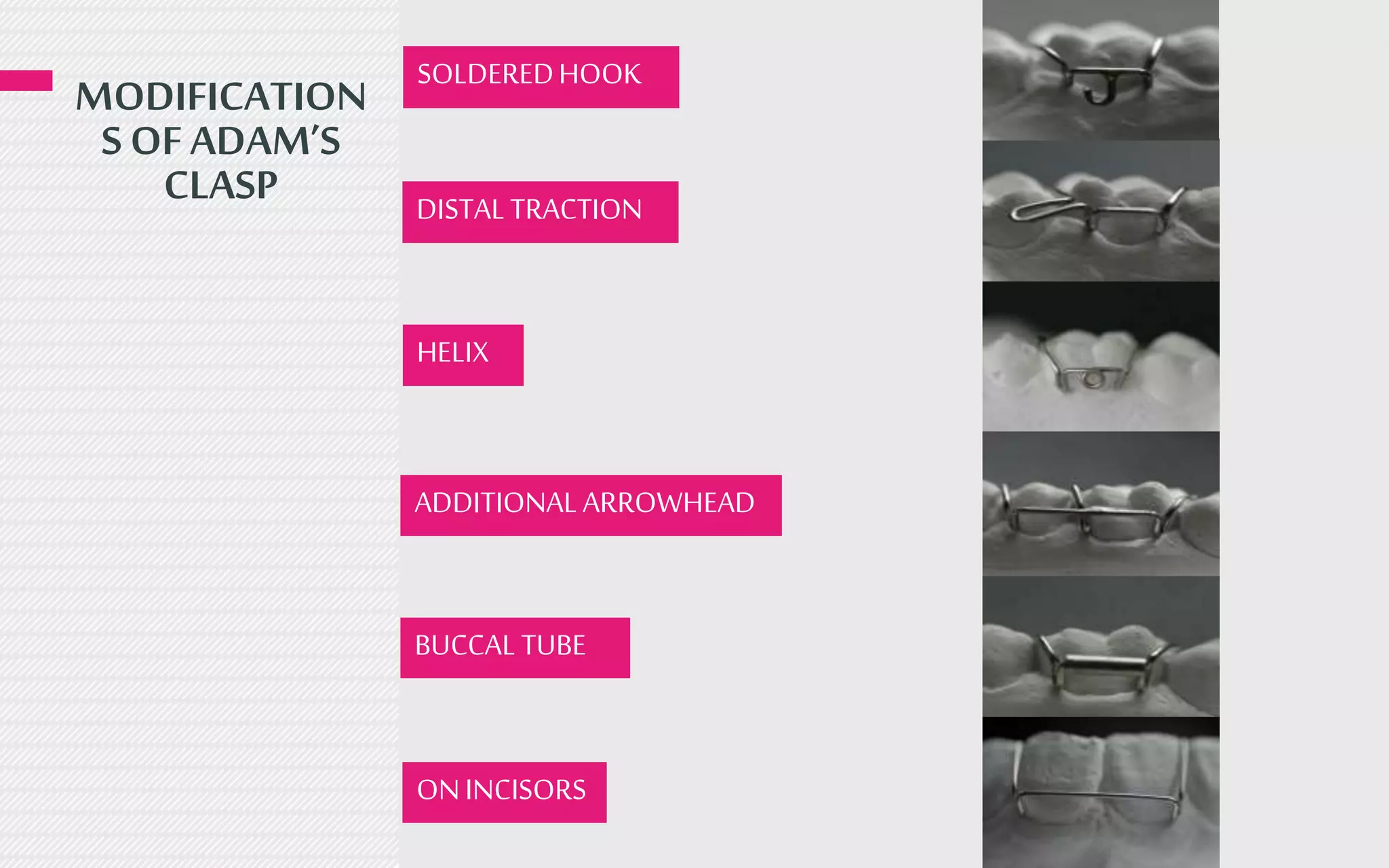 MODIFICATION
S OF ADAM’S
CLASP
SOLDEREDHOOK
DISTALTRACTION
HELIX
ADDITIONALARROWHEAD
BUCCALTUBE
ONINCISORS
 