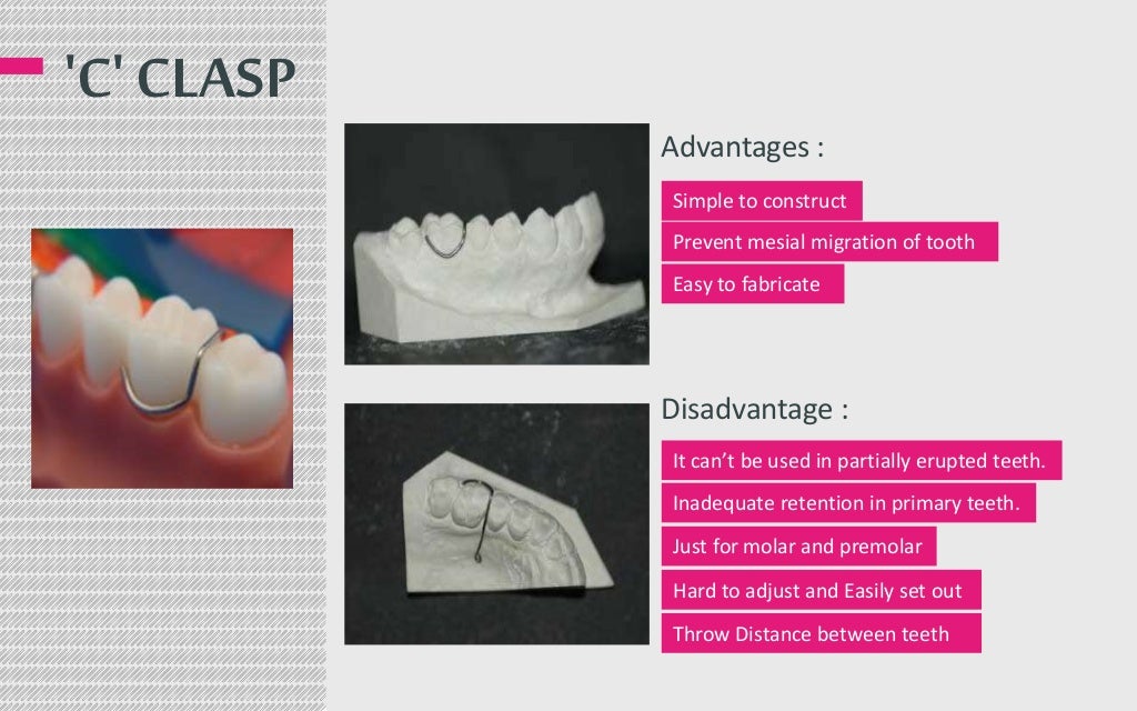 clasps in removable orthodontic appliance