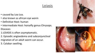 Loiasis
• caused by Loa Loa.
• also known as african eye worm
• Definitive Host: human
• Intermediate Host: horsefly genus Chrysops.
Diseases
1.LOIASIS is often asymptomatic.
2. Episodic angioedema and subconjunctival
migration of an adult worm can occur.
3. Calabar swelling.
 