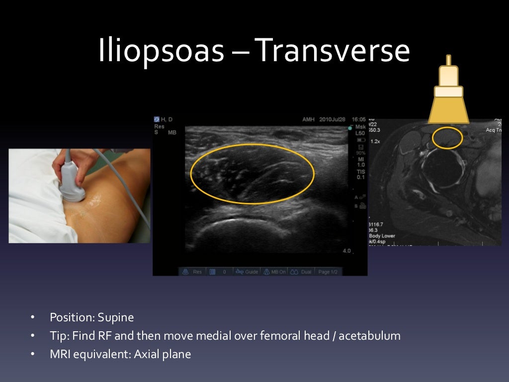 Ultrasound Hip