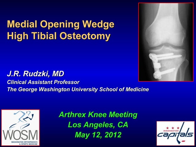 Medial Opening Wedge High Tibial Osteotomy | PPT | Bone and Joint ...