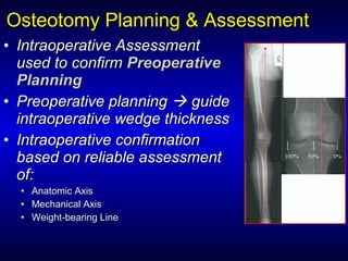 • Intraoperative AssessmentIntraoperative Assessment
used to confirmused to confirm PreoperativePreoperative
PlanningPlanning
• Preoperative planningPreoperative planning  guideguide
intraoperative wedge thicknessintraoperative wedge thickness
• Intraoperative confirmationIntraoperative confirmation
based on reliable assessmentbased on reliable assessment
of:of:
• Anatomic AxisAnatomic Axis
• Mechanical AxisMechanical Axis
• Weight-bearing LineWeight-bearing Line
Osteotomy Planning & AssessmentOsteotomy Planning & Assessment
 