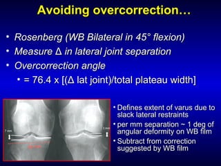 Avoiding overcorrection…Avoiding overcorrection…
• Rosenberg (WB Bilateral in 45° flexion)Rosenberg (WB Bilateral in 45° flexion)
• MeasureMeasure ΔΔ in lateral joint separationin lateral joint separation
• Overcorrection angleOvercorrection angle
• = 76.4 x [(Δ lat joint)/total plateau width]= 76.4 x [(Δ lat joint)/total plateau width]
• Defines extent of varus due toDefines extent of varus due to
slack lateral restraintsslack lateral restraints
• per mm separation ~ 1 deg ofper mm separation ~ 1 deg of
angular deformity on WB filmangular deformity on WB film
• Subtract from correctionSubtract from correction
suggested by WB filmsuggested by WB film
 