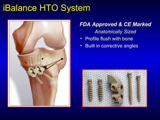 iBalanceiBalance HTO SystemHTO System
FDA Approved & CE MarkedFDA Approved & CE Marked
Anatomically SizedAnatomically Sized
• Profile flush with boneProfile flush with bone
• Built in corrective anglesBuilt in corrective angles
 