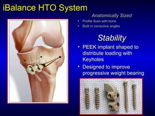iBalanceiBalance HTO SystemHTO System
Anatomically SizedAnatomically Sized
• Profile flush with boneProfile flush with bone
• Built in corrective anglesBuilt in corrective angles
StabilityStability
• PEEK implant shaped toPEEK implant shaped to
distribute loading withdistribute loading with
KeyholesKeyholes
• Designed to improveDesigned to improve
progressive weight bearingprogressive weight bearing
 