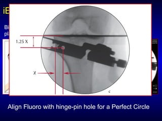 iBalanceiBalance HTO SystemHTO System
Biplanar Alignment Guide facilitates precise
placement of cutting guides
Align Fluoro with hinge-pin hole for a Perfect Circle
 